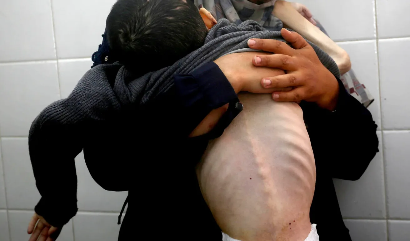 ارتفاع أعداد شهداء التجويع في غزة إلى 300 فلسطيني بينهم 117 طفلاً